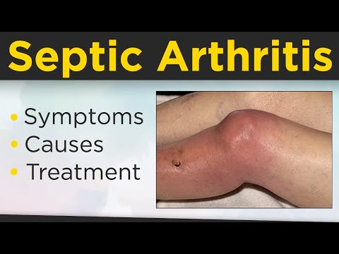 😱 What is Septic Arthritis? 💹Septic Arthritis Symptoms, Causes, Risk Factors And Treatment