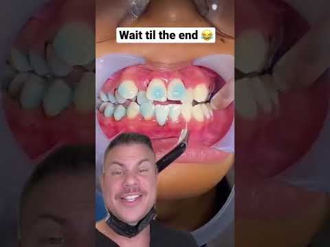 How Braces Are Put On